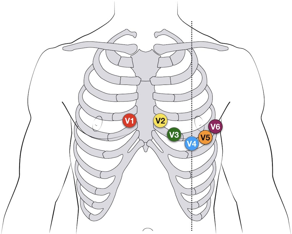 Limb leads of EKG — Npatchett (Wikimedia)
