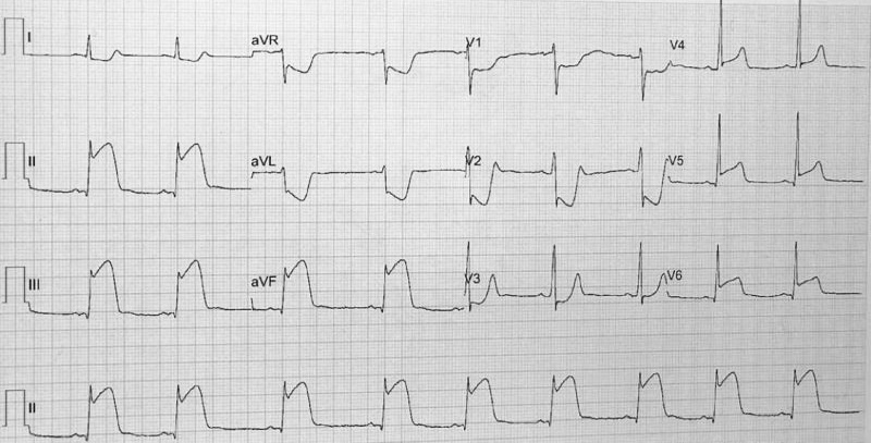 EKG-LA — Comparación de Patrones